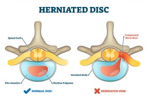 Read more about the article What is a Herniated Disc?