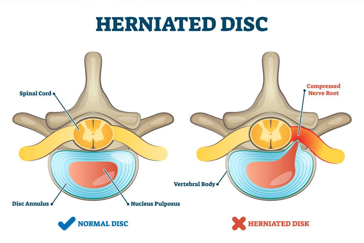 You are currently viewing What is a Herniated Disc?