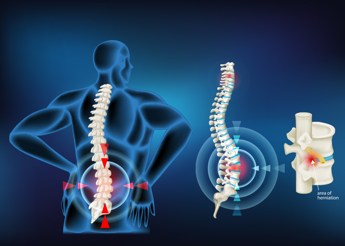 Spine Anatomy - Buffalo Back and Neck PT