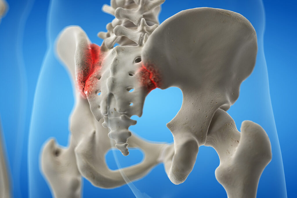 sacroiliac joint injection