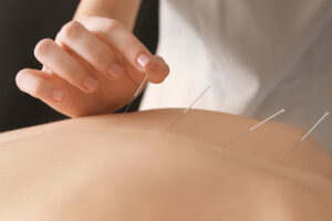 Read more about the article Acupuncture for back pain