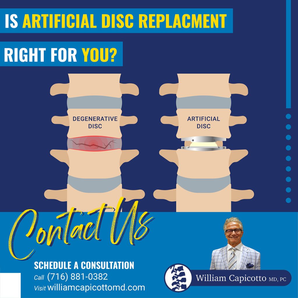 Artificial Disc Replacement: Dr. William Capicotto MD specializes in minimally invasive spine surgeries to eliminate back and neck pain. 