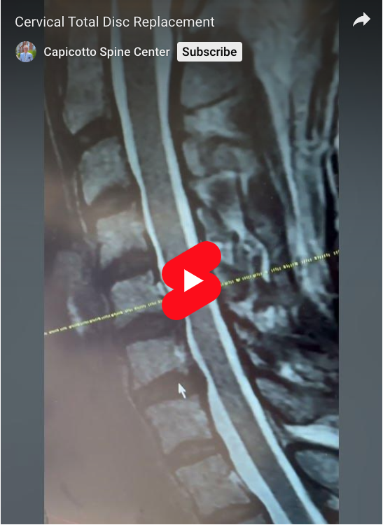 Take a closer look at some disc herniations and how we navigate the intricacies of a life changing procedure: Cervical Total Disc Replacement.