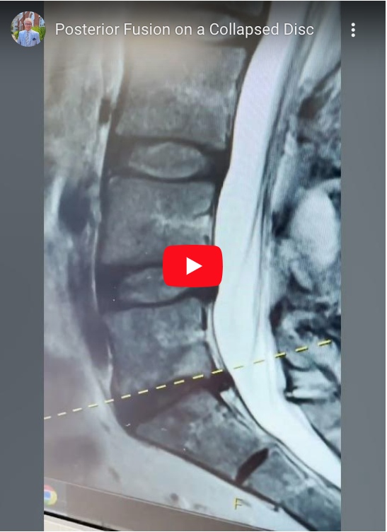 Read more about the article Posterior Fusion on a Collapsed Disc