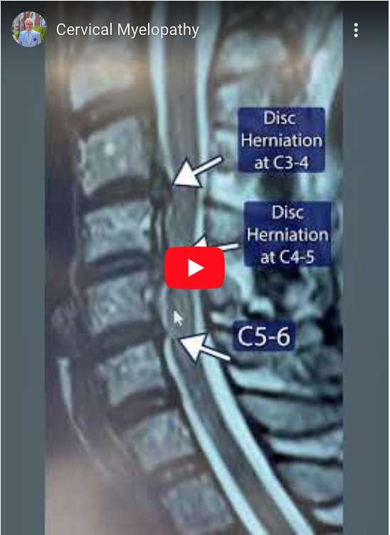 Read more about the article Cervical Myelopathy