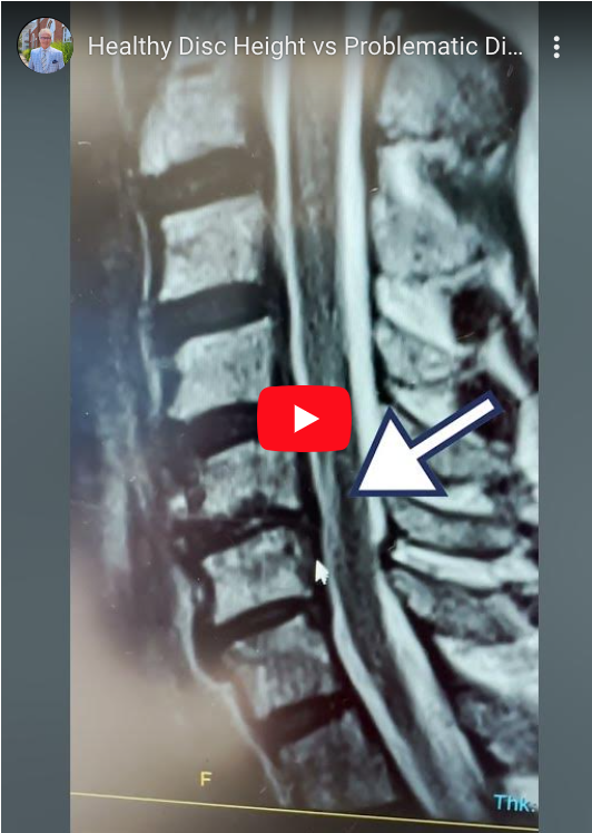 Read more about the article Healthy Disc Height vs Problematic Disc Height