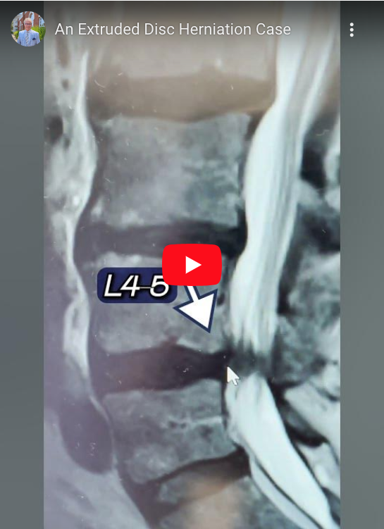 Have you heard of an extruded disc herniation?