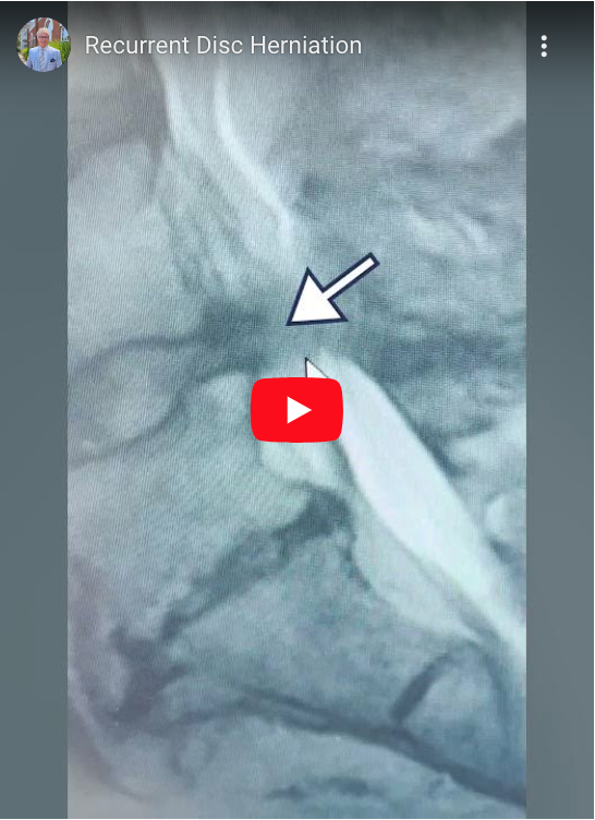 Read more about the article Recurrent Disc Herniation