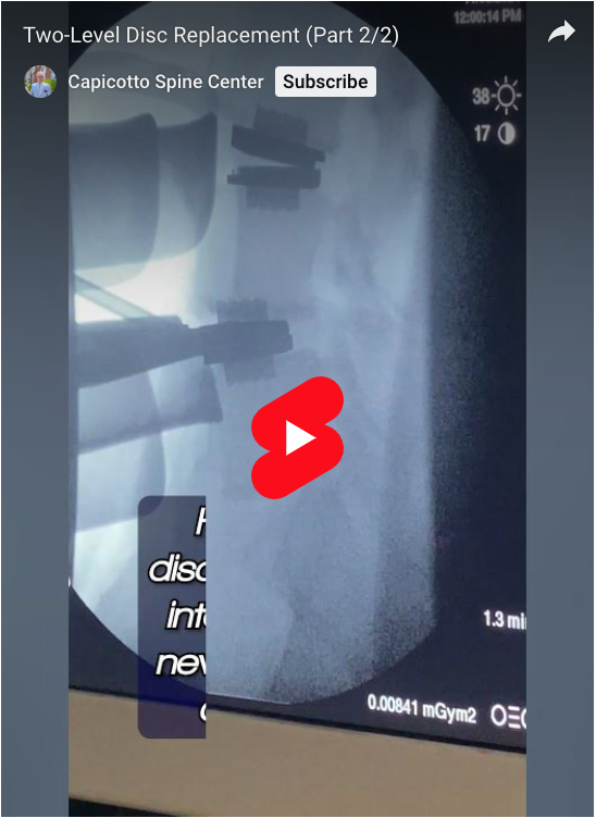 (Part 2/2) How do I create room to properly insert an artificial disc? Let me show you how I tackled this 2 level disc replacement to alleviate a patient's pain.