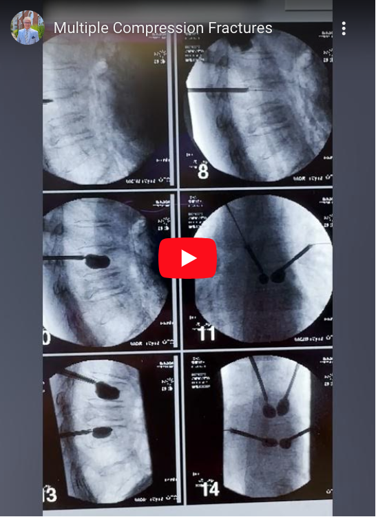 For this elderly patient, I didn’t want to be too aggressive but with multiple compression fractures causing disabling pain, kyphoplasty was the best option for providing relief.