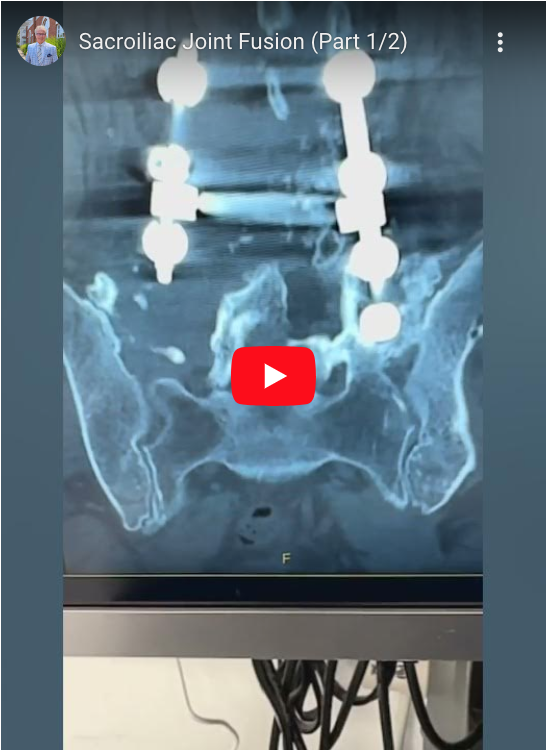 Read more about the article Sacroiliac Joint Fusion (Part 1/2)