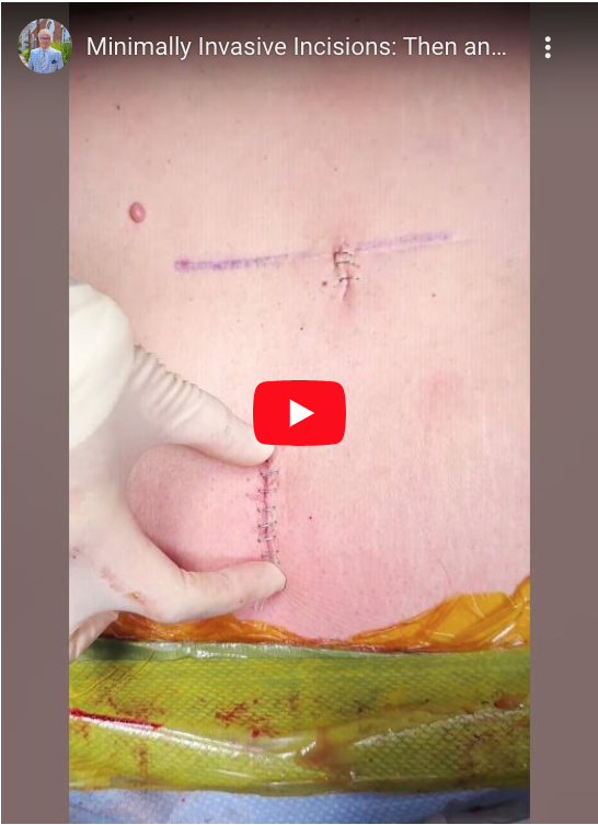 Watch to the end to see the difference in incision length from their fusion 10+ years ago to their newest procedure!