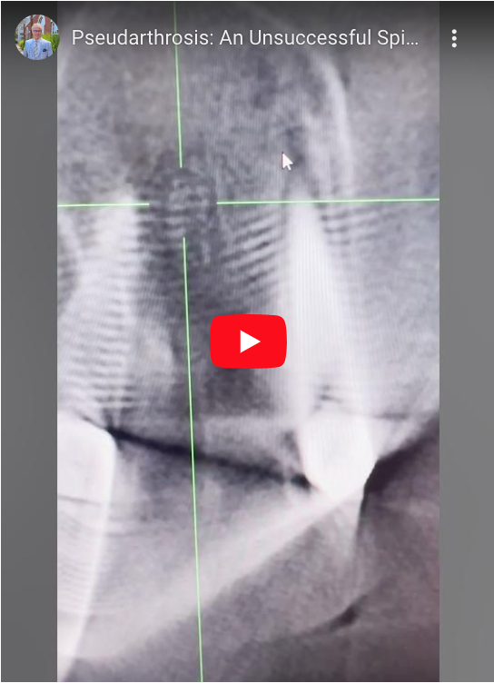 Read more about the article Pseudarthrosis: An Unsuccessful Spinal Fusion