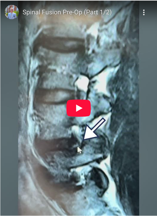 Read more about the article Spinal Fusion Pre-Op (Part 1/2)