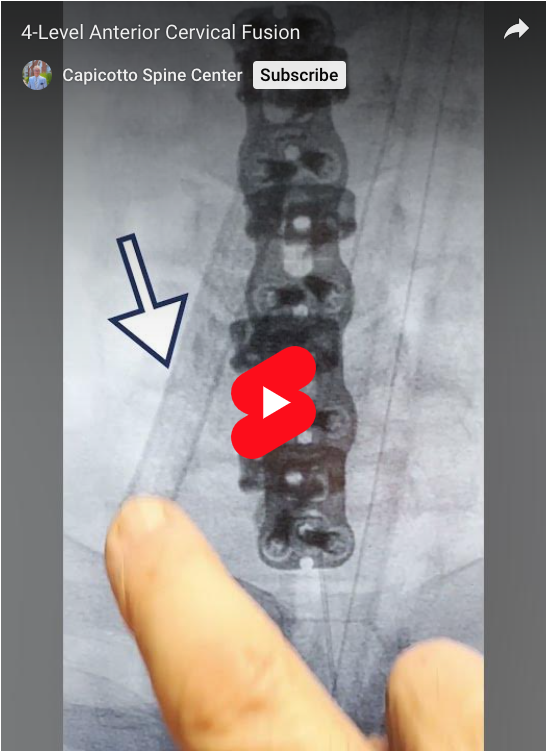 Check out this before and after where I performed a 4-level anterior cervical fusion to align their neck better and alleviate pain.