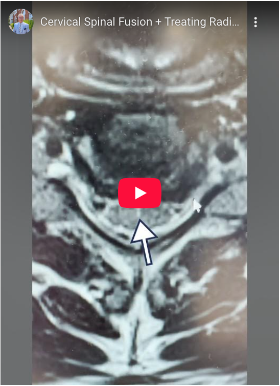 When examining this patient I discovered several abnormalities, the most significant being a disc herniation at C5-6 (cervical/neck region of the spine) and severe radiculopathy where the spinal cord is being pinched.