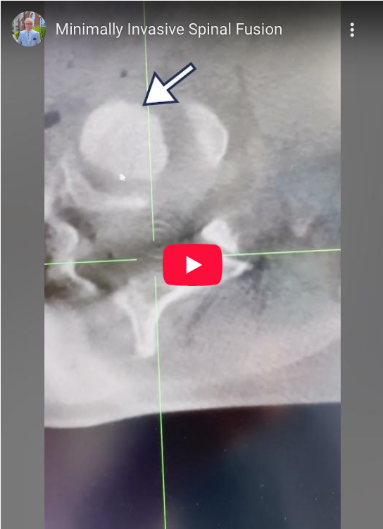 This patient had two herniated discs, plus a little spondylolisthesis. Let's take a closer look at this minimally invasive spinal fusion.