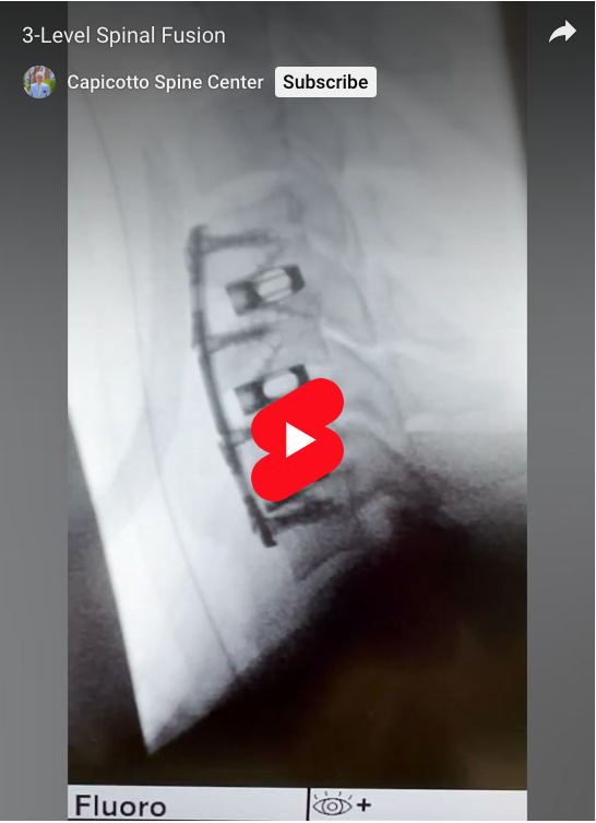 Read more about the article 3-Level Spinal Fusion