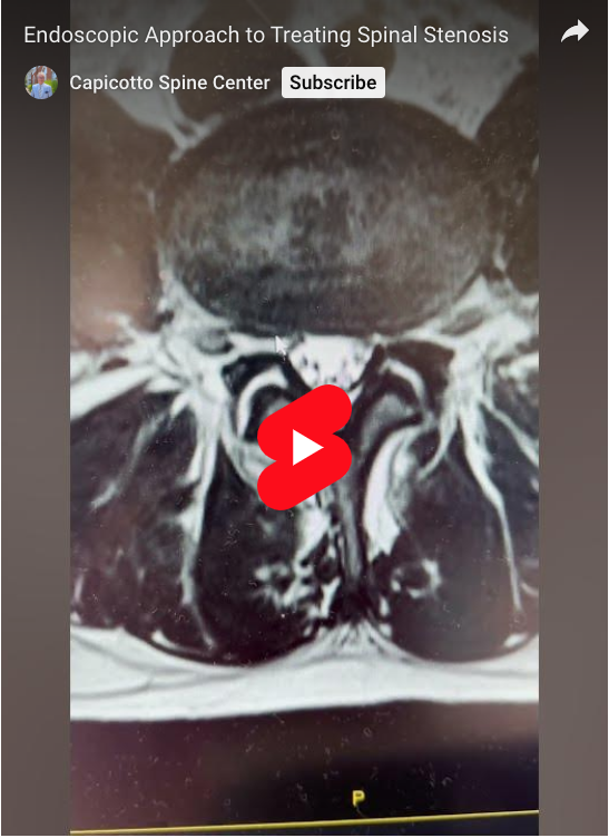 Read more about the article Endoscopic Approach to Treating Spinal Stenosis
