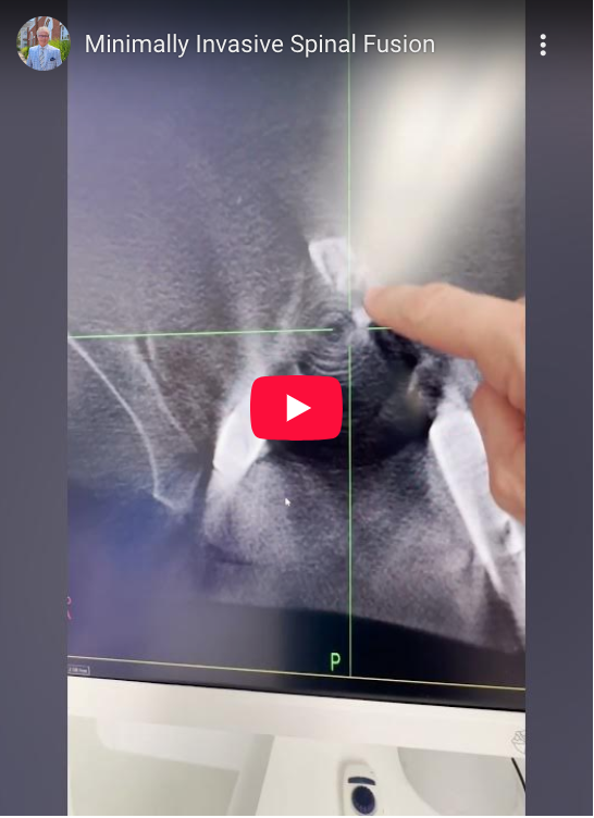 Read more about the article Minimally Invasive Spinal Fusion