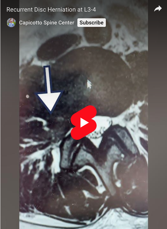 Read more about the article Recurrent Disc Herniation at L3-4