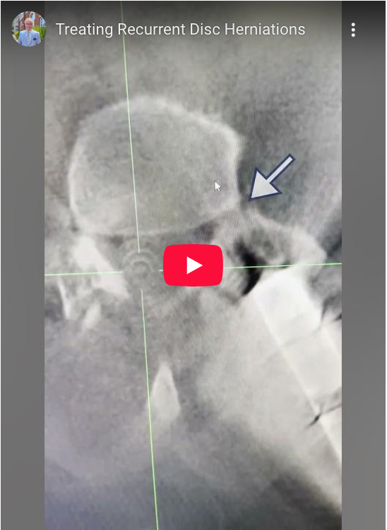Read more about the article Treating Recurrent Disc Herniations