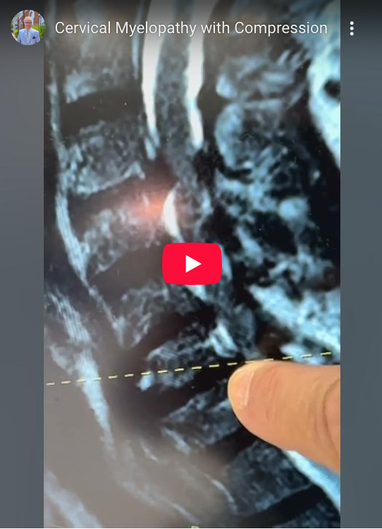 For this patient with a cervical myelopathy with compression and disc herniation, I'm performing an anterior cervical discectomy and fusion.