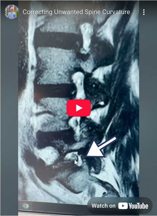 For this patient with herniations and left-sided pain, we're going to push that vertebrae to level and correct this unwanted spine curvature.