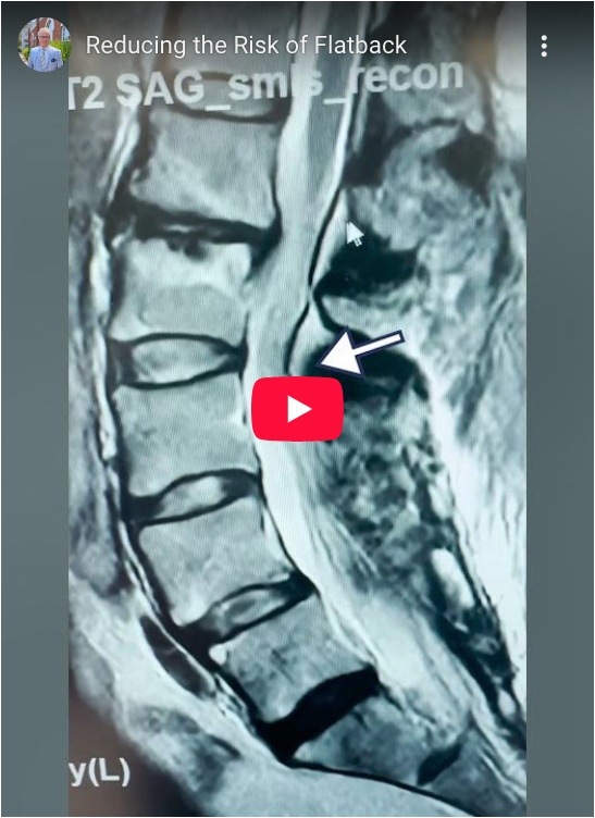 Read more about the article Reducing the Risk of Flatback