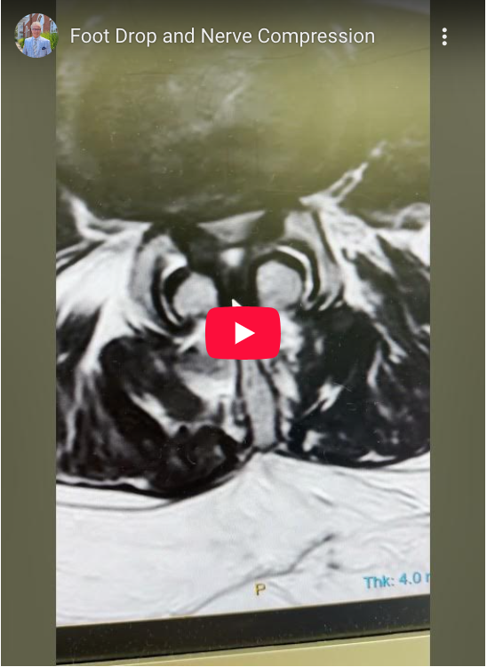 Read more about the article Foot Drop and Nerve Compression