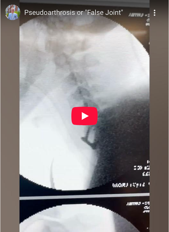 Read more about the article Pseudoarthrosis or “False Joint” 