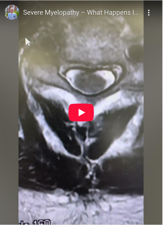 Read more about the article Severe Myelopathy – What Happens If Not Caught?