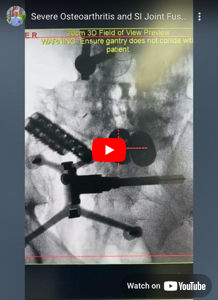 This patient is a good example of long term problems that can occur with long spinal fusions, such as severe osteoarthritis in the SI joint.