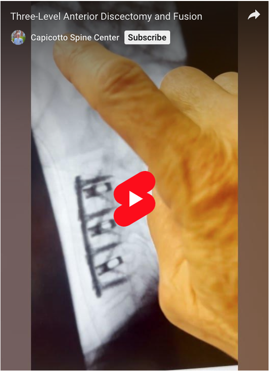 Read more about the article Three-Level Anterior Discectomy and Fusion