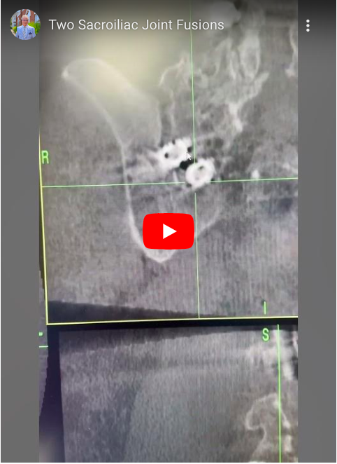 Let me show you a closer look at two recent SI Joint Fusions I completed to clarify further.