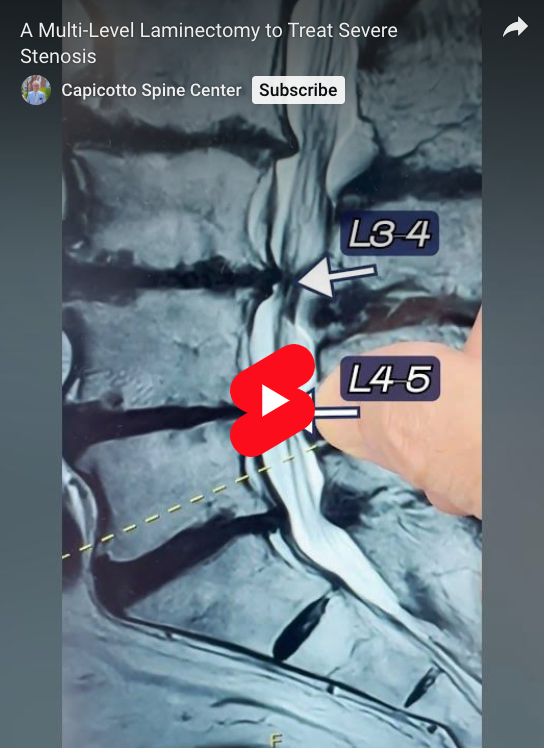 Read more about the article A Multi-Level Laminectomy to Treat Severe Stenosis