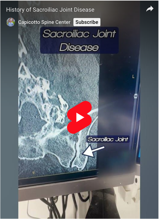 Read more about the article History of Sacroiliac Joint Disease