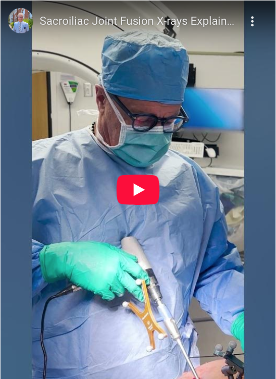 Read more about the article Sacroiliac Joint Fusion X-rays Explained