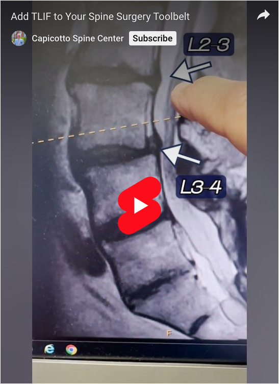 Read more about the article Add TLIF to Your Spine Surgery Toolbelt