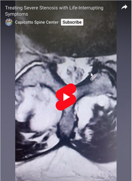 For this patient with severe stenosis in their lower back, decompression is essential. But let me show you what makes this case tricky.