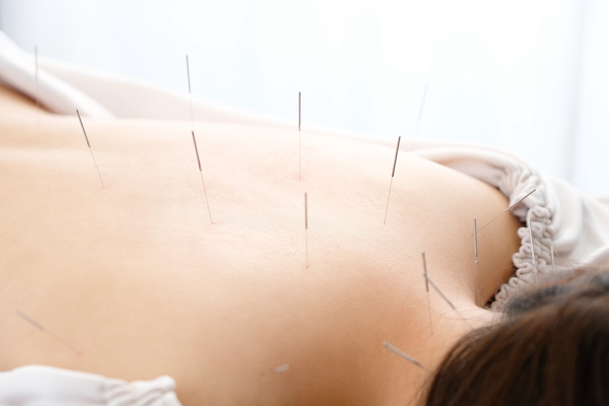 Read more about the article The Role of Acupuncture in Treating Back Pain