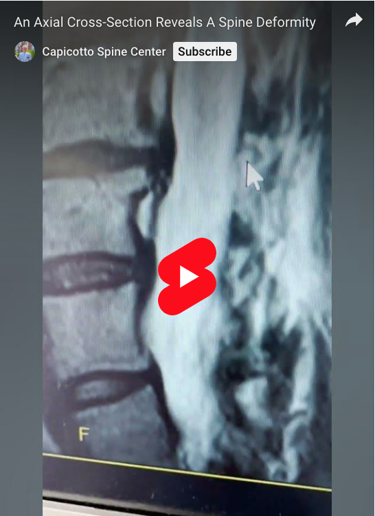 This axial cross-section shows something interesting: a spine deformity.