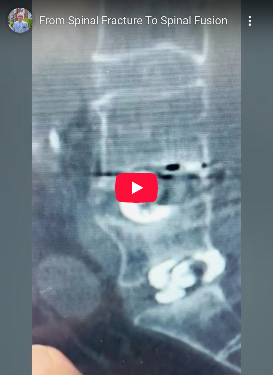 Read more about the article From Spinal Fracture To Spinal Fusion