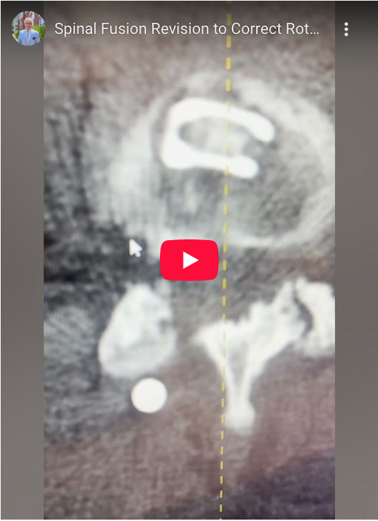 Read more about the article Spinal Fusion Revision to Correct Rotated Implant