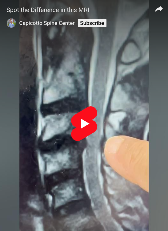 Let’s play a game: spot the difference! The first MRI was taken in June 2025. The second in November 2024.