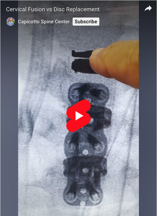 Read more about the article Cervical Fusion vs Disc Replacement