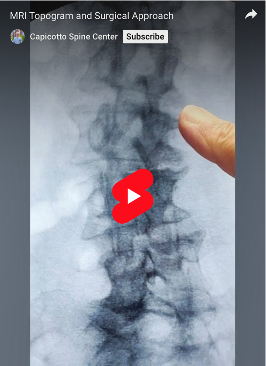 Read more about the article MRI Topogram and Surgical Approach