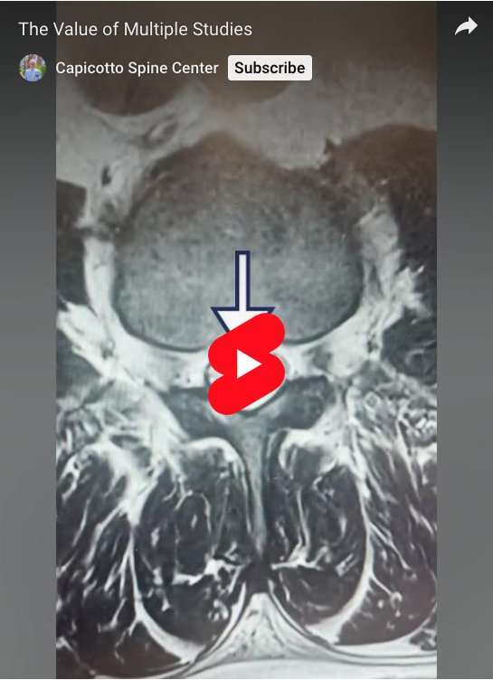 One lesson you learn performing spine surgery is that doing multiple studies over a period of time can be quite valuable for assessingĀ a patient.