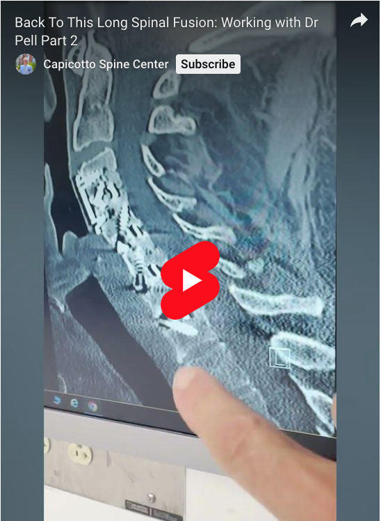 While the kids go back to school, we’re going back to this long cervical spinal fusion with Part 2 of the extended edition!