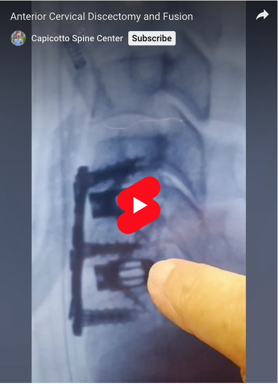 Read more about the article Anterior Cervical Discectomy and Fusion